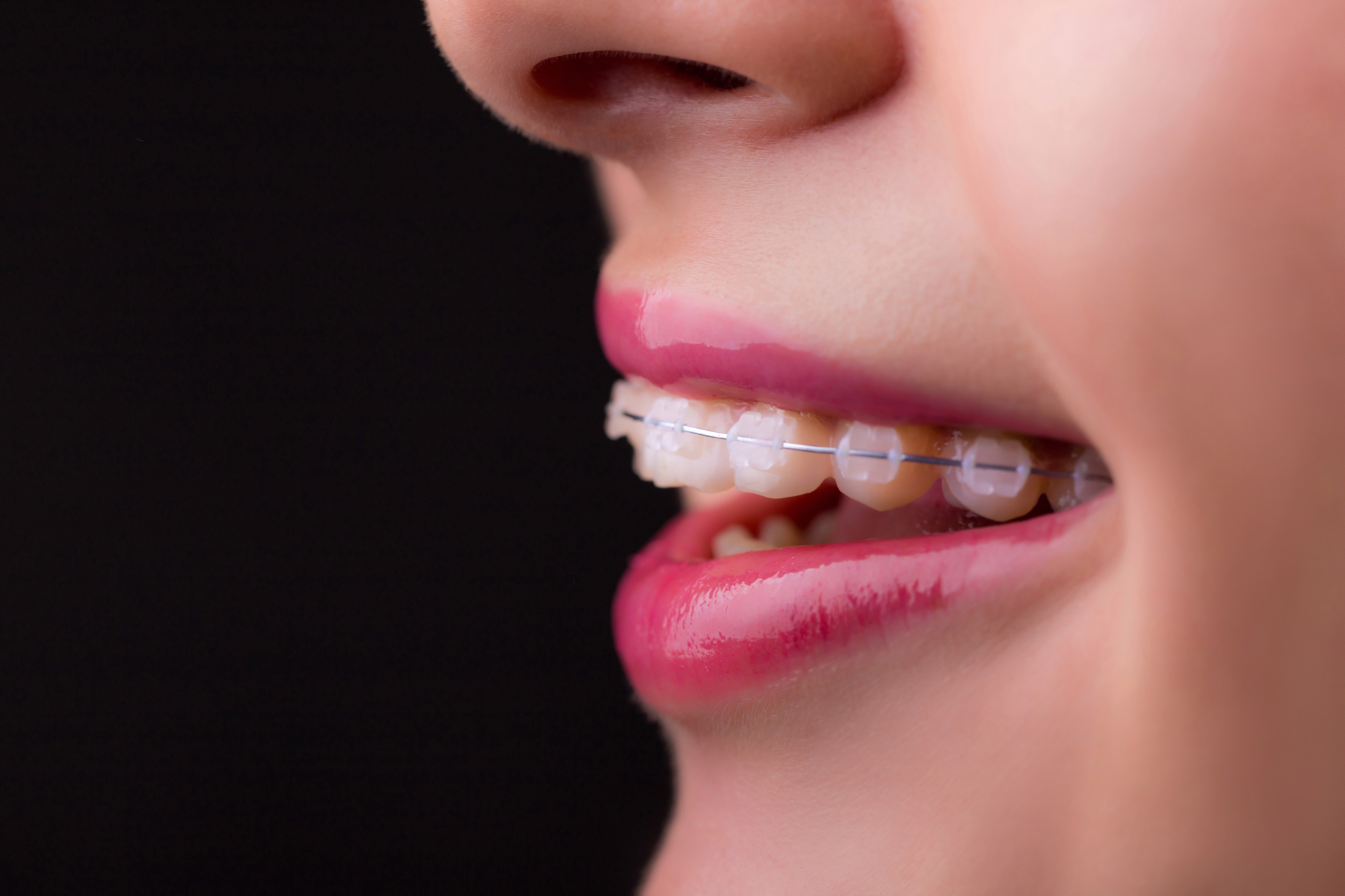 Kako sva s prijateljem priklicala osebo, ki ji ortodont pomaga do lepših zob